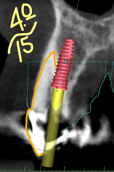 Fig. 7b: Implant in position #13.