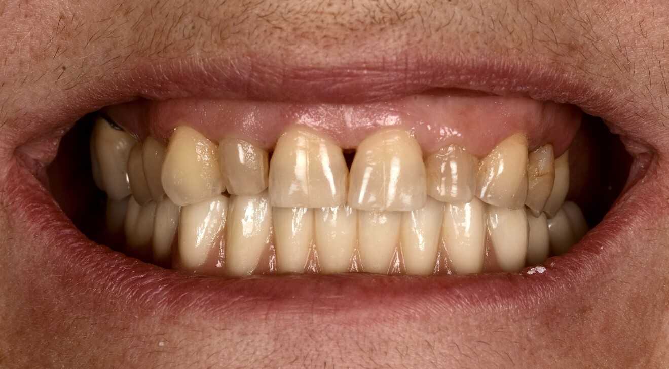 Fig. 16f: Final frontal view of the patient’s smile.