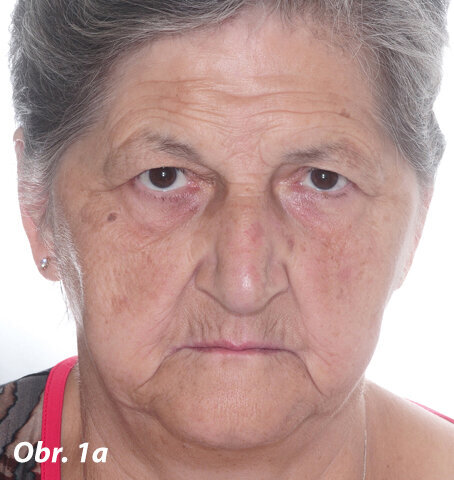 Pacientka požadující okamžité a finančně dostupné ošetření bezzubé horní a dolní čelisti