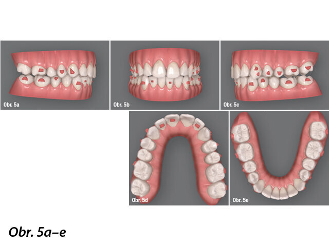 Plánování alignerů v programu ClinCheck (začátek).