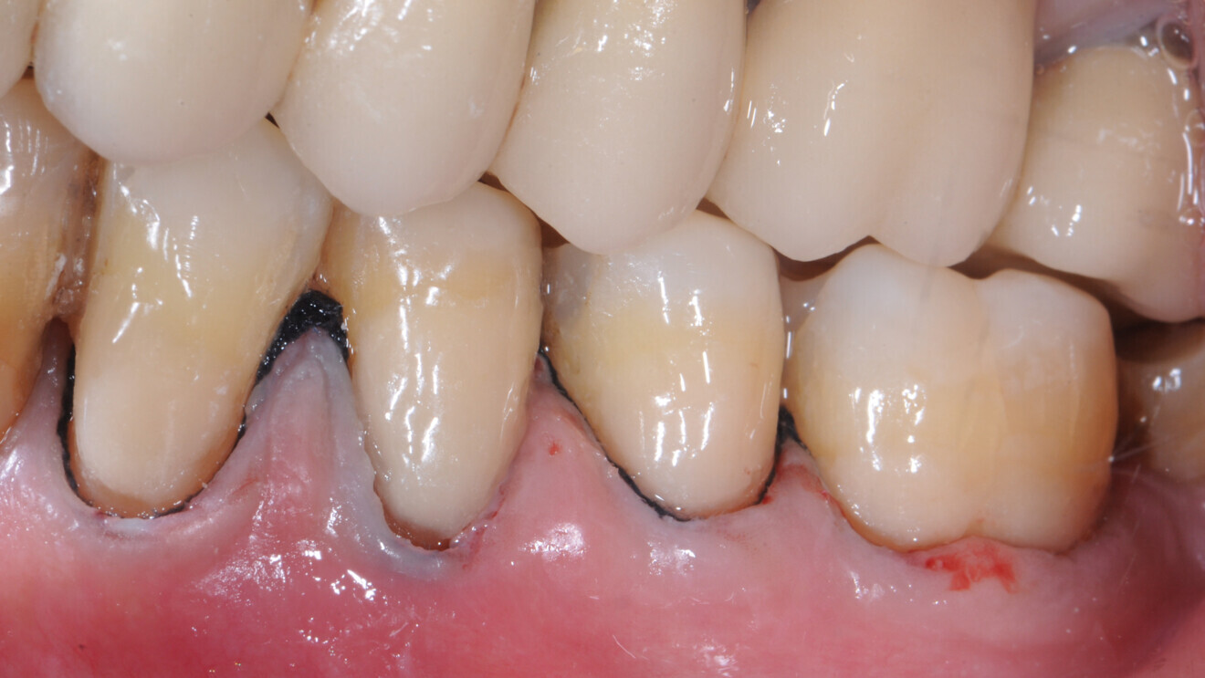 Fig. 4b : Restauration initiale par un verre hybride.