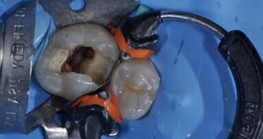 Trattamento endodontico ortogrado con strumenti trattati termicamente