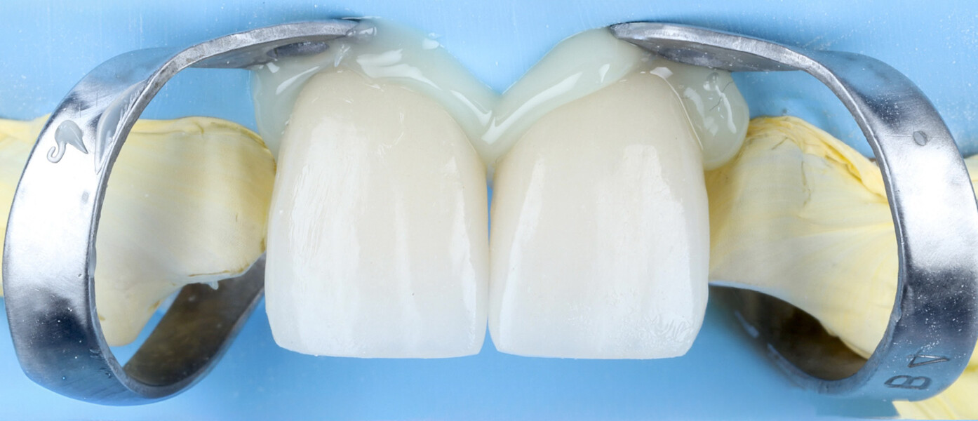 Fig. 19b: Simultaneous placement of the central incisor veneers prior to removal of excess cement. 