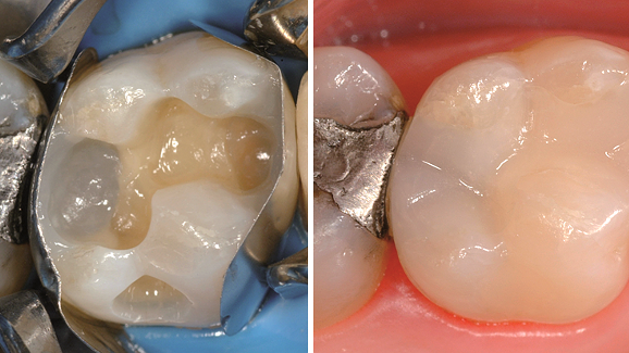 Webinar hinterfragt Wirtschaftlichkeit von Kompositversorgungen