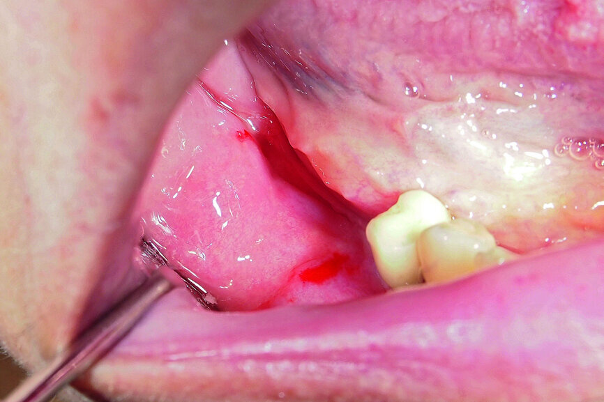 Fig. 14: Preoperative intraoral finding in the atrophic posterior mandible.