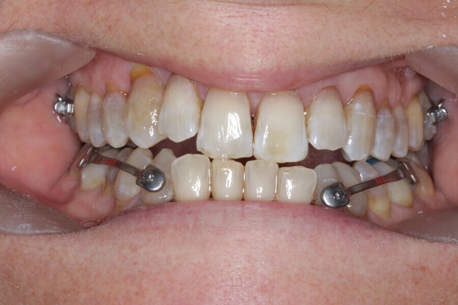 Fig. 30: Placement of the Carriere Motion 3D Class III appliance.
