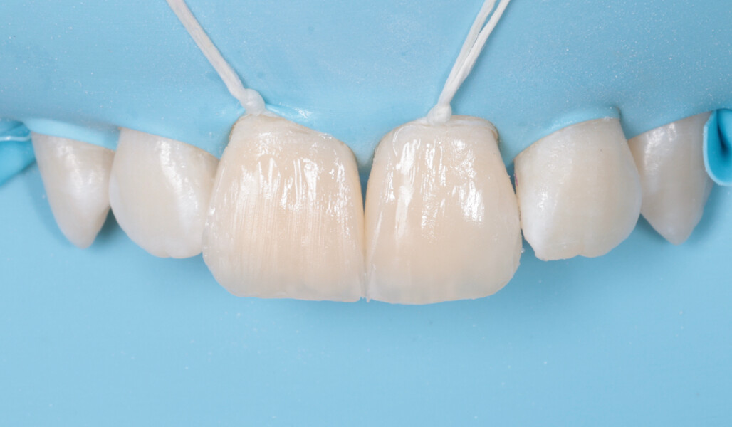Fig. 17: Both restorations built up.