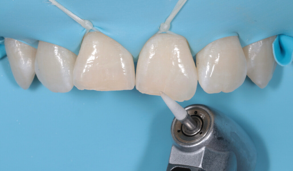 Fig. 7: Use of an Arkansas stone for tooth preparation.