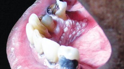 The keys to early cancer diagnosis: careful examination & timely biopsy