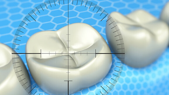 Vormarsch der unbehandelten Karieserkrankungen
