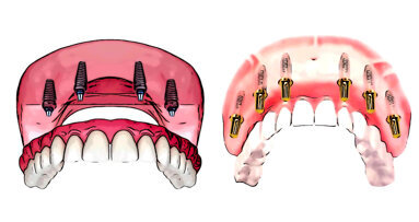 Mise en charge immédiate ou différée chez l’édenté complet maxillaire