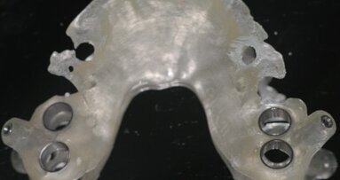 Le nuove tecnologie in implantoprotesi