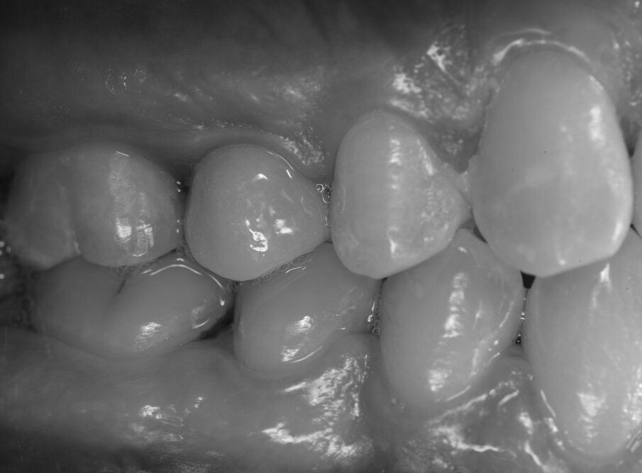 Fig. 6_Il bianco/nero della foto esalta le forme e la mimesi anatomica delle corone e dei tessuti.