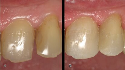 Restauraciones de clase III y IV con composite termoviscoso