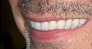 Od diagnostyki do protetyki – współpraca, komunikacja, realizacja.  II etap leczenia