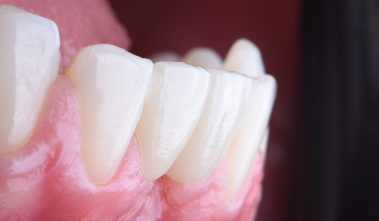 Fig. 12: Lateral view at 18 months.