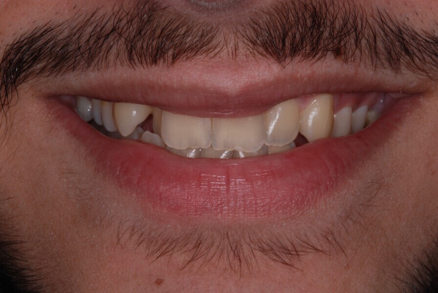 Fig. 27: Smile frontal view before treatment.