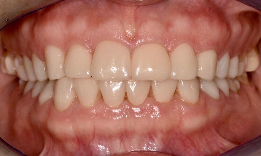 Fig. 11a: Temporarily cemented long-term provisional restorations. Frontal view.