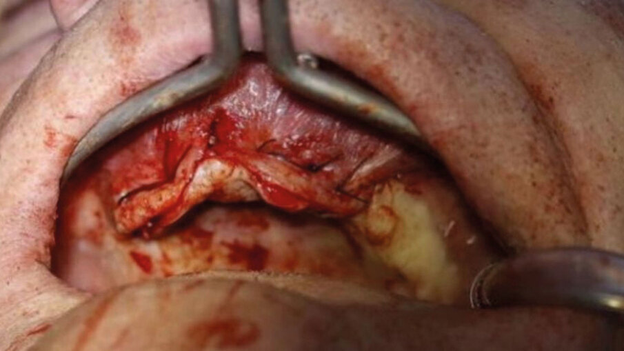 Fig. 6 - Foto chiusura tramite punti riassorbibili. Fine Intervento con durata massimo 18/20 minuti suture comprese.