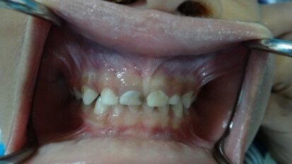 The “All Hall” case: Maximum capacity use of the Hall technique in a single child patient