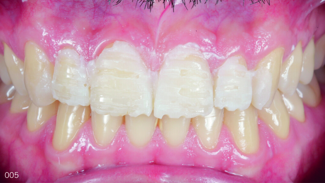 Fig. 5: Operative phase in which the mock-up acted as a guide for highly conservative, controlled preparations.