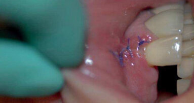 Reconstruction osseuse pré-implantaire par bloc d’os allogénique sur mesure