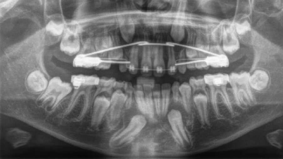 Fig. 6_RX OPT con inclusione dell’elemento 4.3.