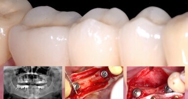 Rehabilitación inmediata con implantes y ROG horizontal