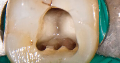 Evoluzione clinica e tecnologica in Endodonzia