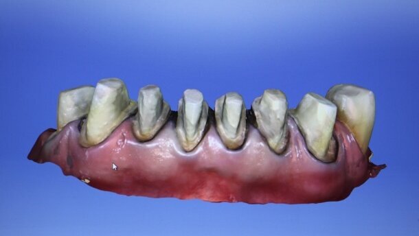 Wielofunkcyjne wykorzystanie systemu CAD/CAM w kompleksowej rehabilitacji zwarcia