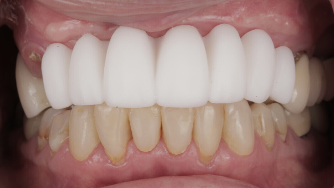 Fig. 5b: 3D-printed intra-oral mock-up to assess lip support and aesthetics. Frontal view (a). Frontal view with retracted lips (b). Occlusal view (c).