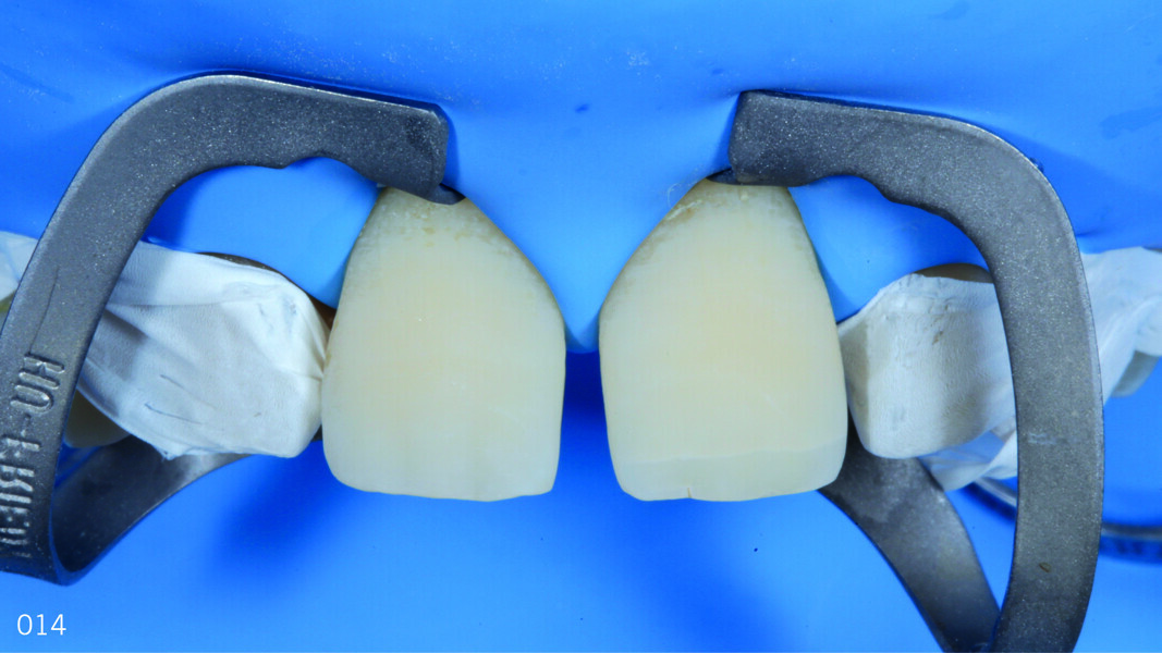 Fig. 13: Isolation using PTFE and appearance of the sandblasted surfaces.