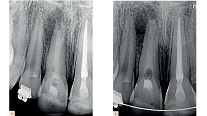 Traitement d’une incisive centrale non vitale avec un apex ouvert, en utilisant un matériel de réparation novateur à base de MTA