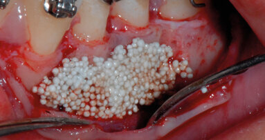 Utilizzo di un innovativo  materiale da innesto nel movimento ortodontico parodontalmente accelerato