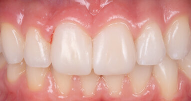 Facettes réalisées en méthode directe avec la technique du composite injecté