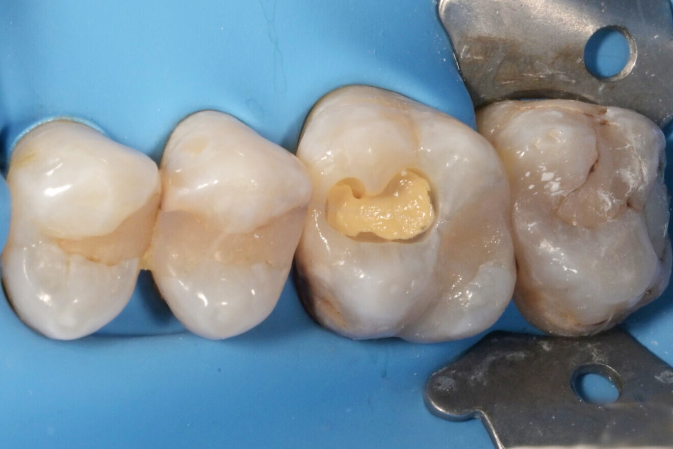 Фиг. 9: Зъбът след нанасяне на универсален адхезив.