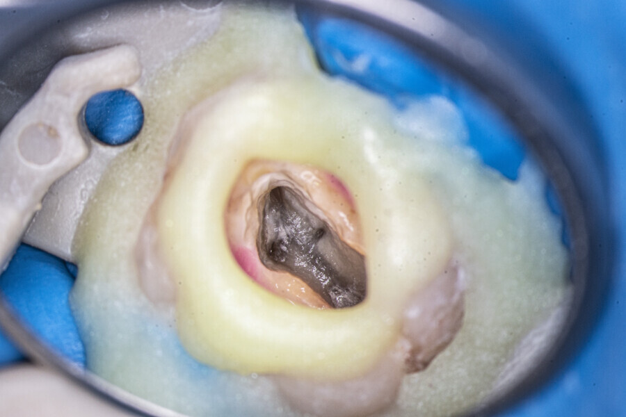 Fig. 56: Buccal side of the pulp chamber once the calcification had been removed. The orifices were patent.