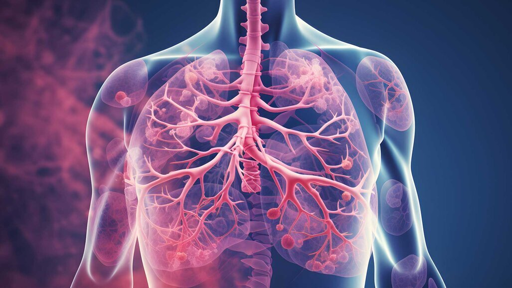 Mikrobielle Verbindung zwischen Parodontitis und COPD entschlüsselt