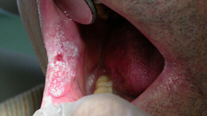 Le correlazioni tra Hpv e carcinoma orofaringeo