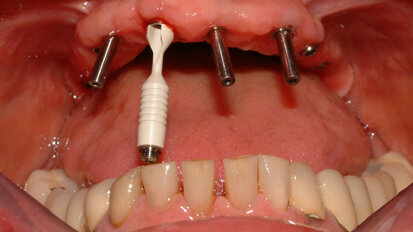 Riabilitazione mascellare full-arch  con strutture avvitate ATLANTIS ISUS  in un caso complesso dal punto di vista estetico