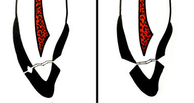 Traumatologia dentale in età pediatrica