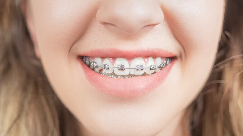Neuer Kleber für Brackets soll vor Kariesbildung schützen