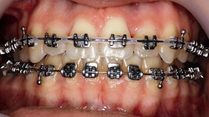 Aesthetics and function: Orthodontic–surgical collaboration as a key to success
