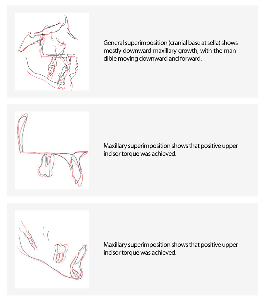 Cephalometric superimpositions (black = initial / red = final)
