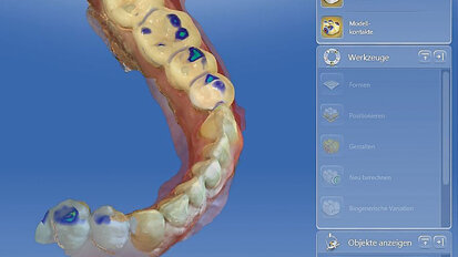 Zvýšení skusu digitálně od A do Z