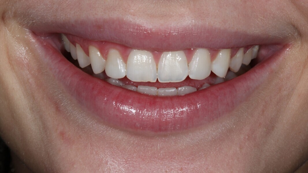 Fig. 17: Extra-orale foto van de uiteindelijke restauratie. 