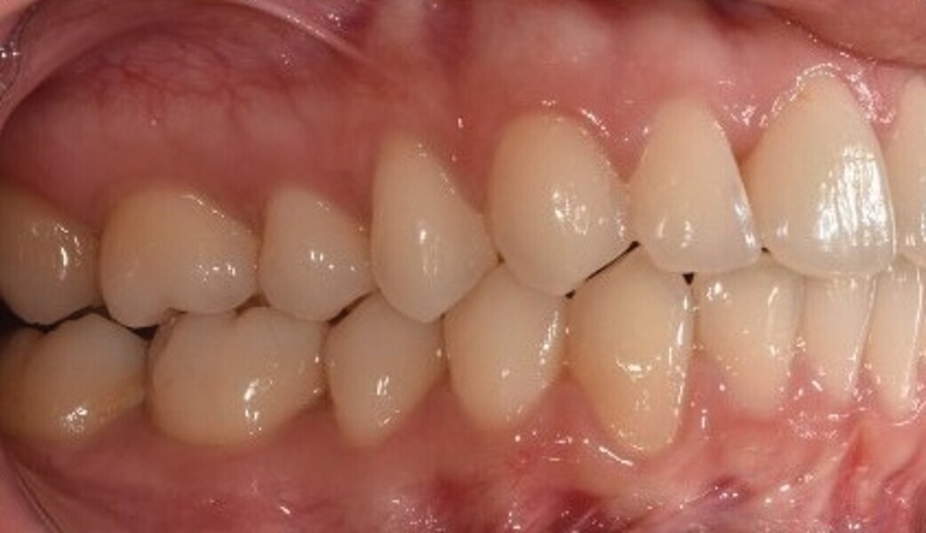 Fig. 6c : Photographie intraorale finale.