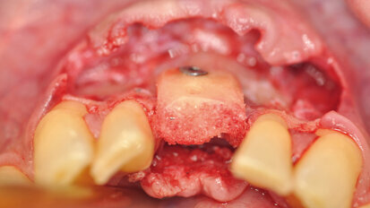 Přežití alogenních kortikospongiózních kostních bloků