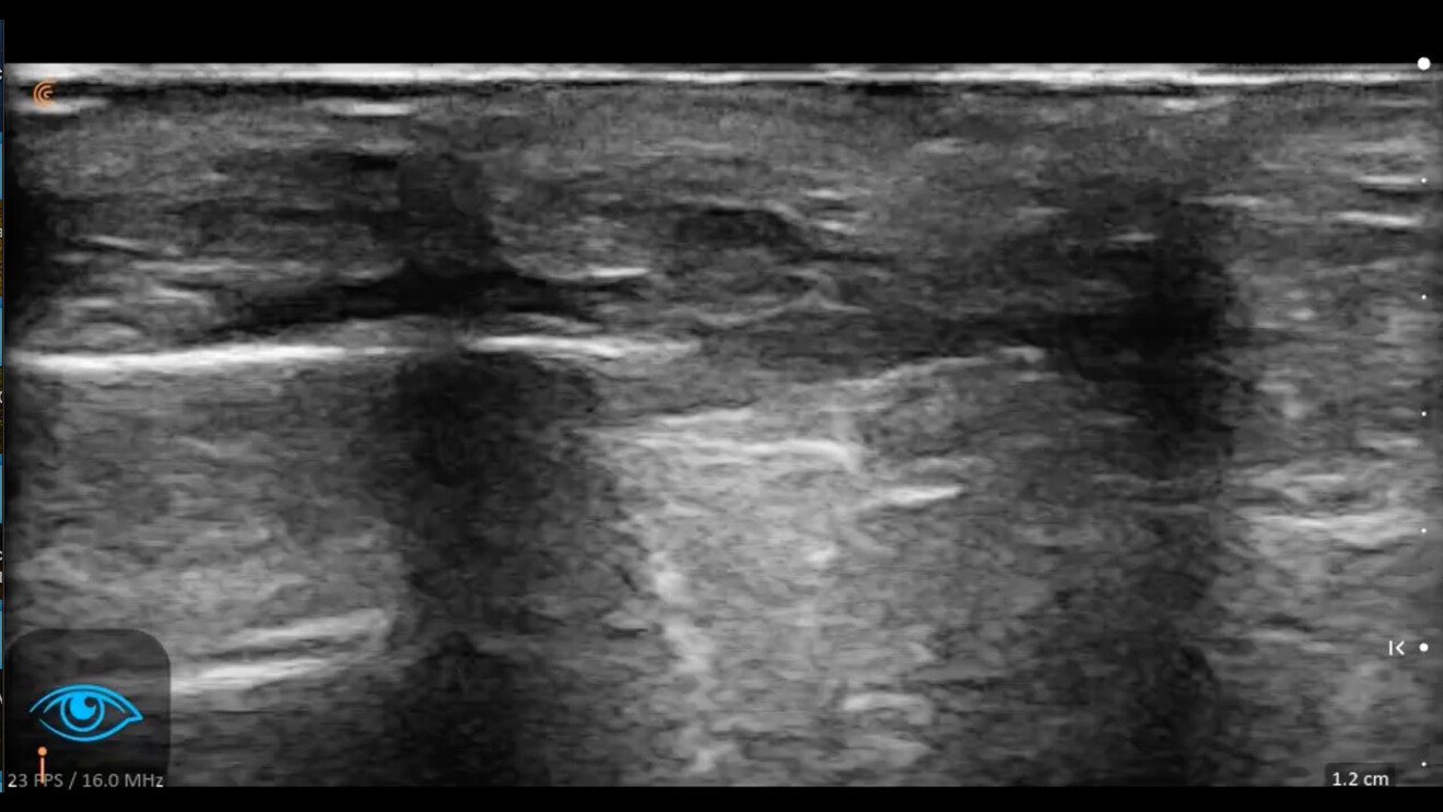 Fig. 3 - Immagine statica della cute e dei tessuti molli della zona infraorbitaria di un soggetto di sesso femminile di 60 aa. Si nota una SLEB (Subepidermal Low Echogenity Band/Banda subepidermica a bassa ecogenicità) e un tessuto adiposo superficiale molto rappresentato (circa 4 mm).