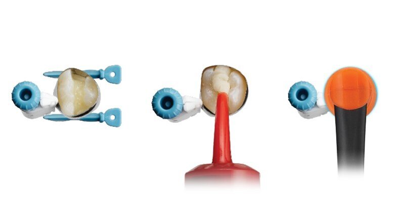 Dentsply Sirona lancia Surefil one: un nuovo composito rivoluzionario